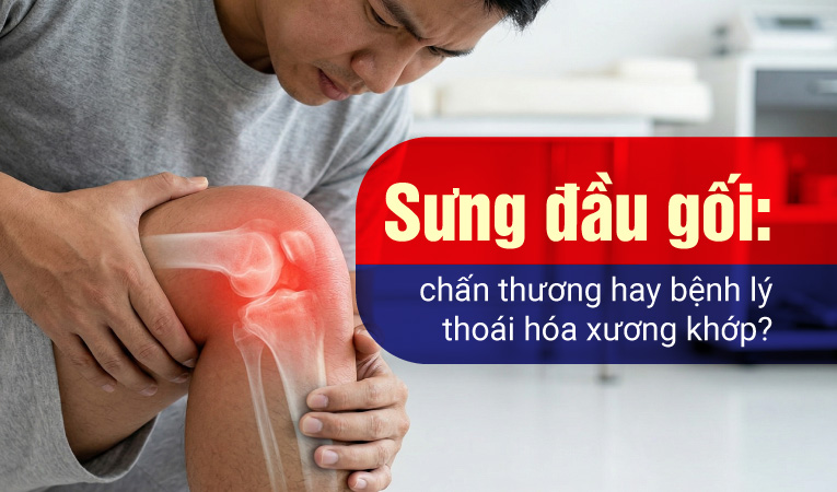 Sưng đầu gối: chấn thương hay bệnh lý thoái hóa xương khớp?