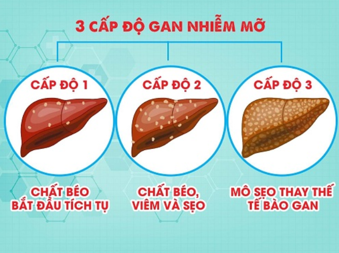 Giải đáp nhanh: làm thế nào để gan nhiễm mỡ độ 2 về độ 0?