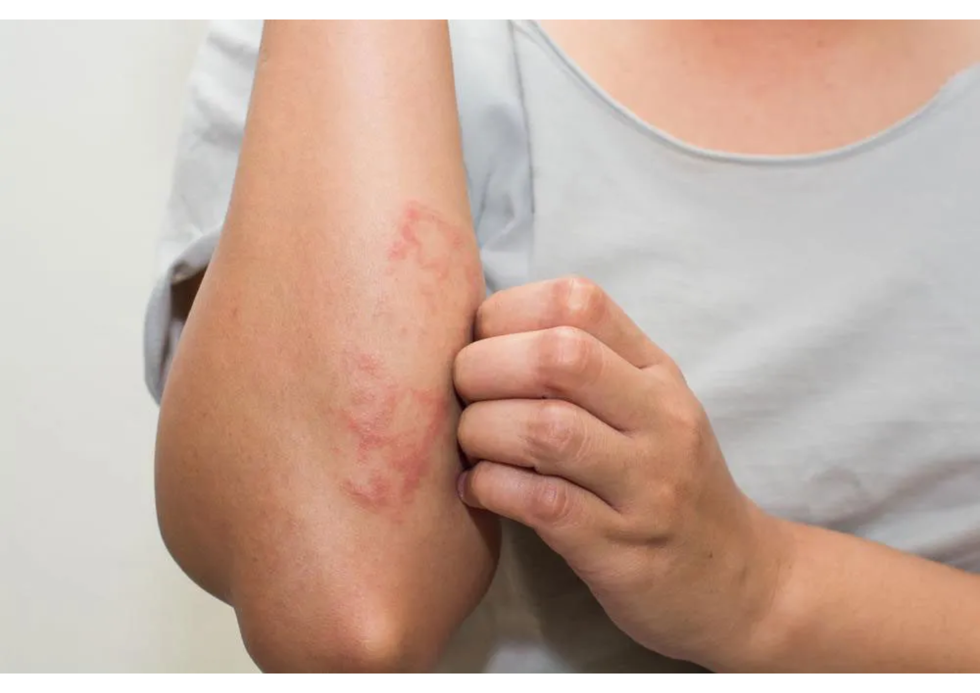 U Sùi Thể Nấm (Mycosis Fungoides): Ung thư Hạch Tế bào T Hiếm Gặp trên Da