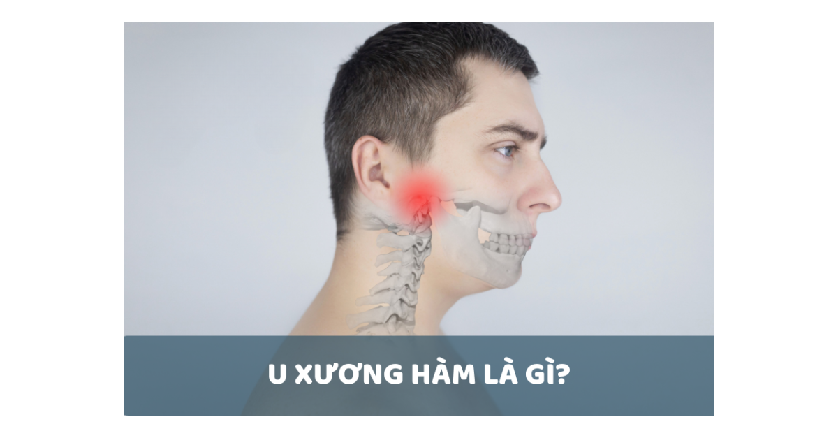 U xương hàm là gì? Những điều cần biết về u xương hàm