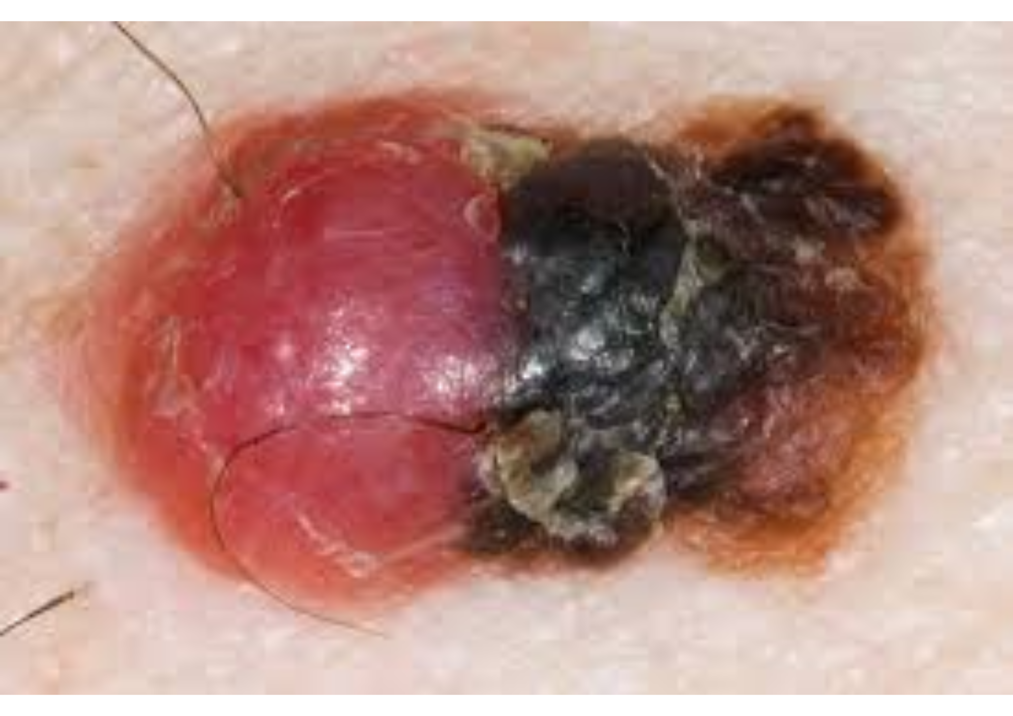 U Tế Bào Hắc Tố (Melanoma): Những điều bạn cần biết về căn bệnh này