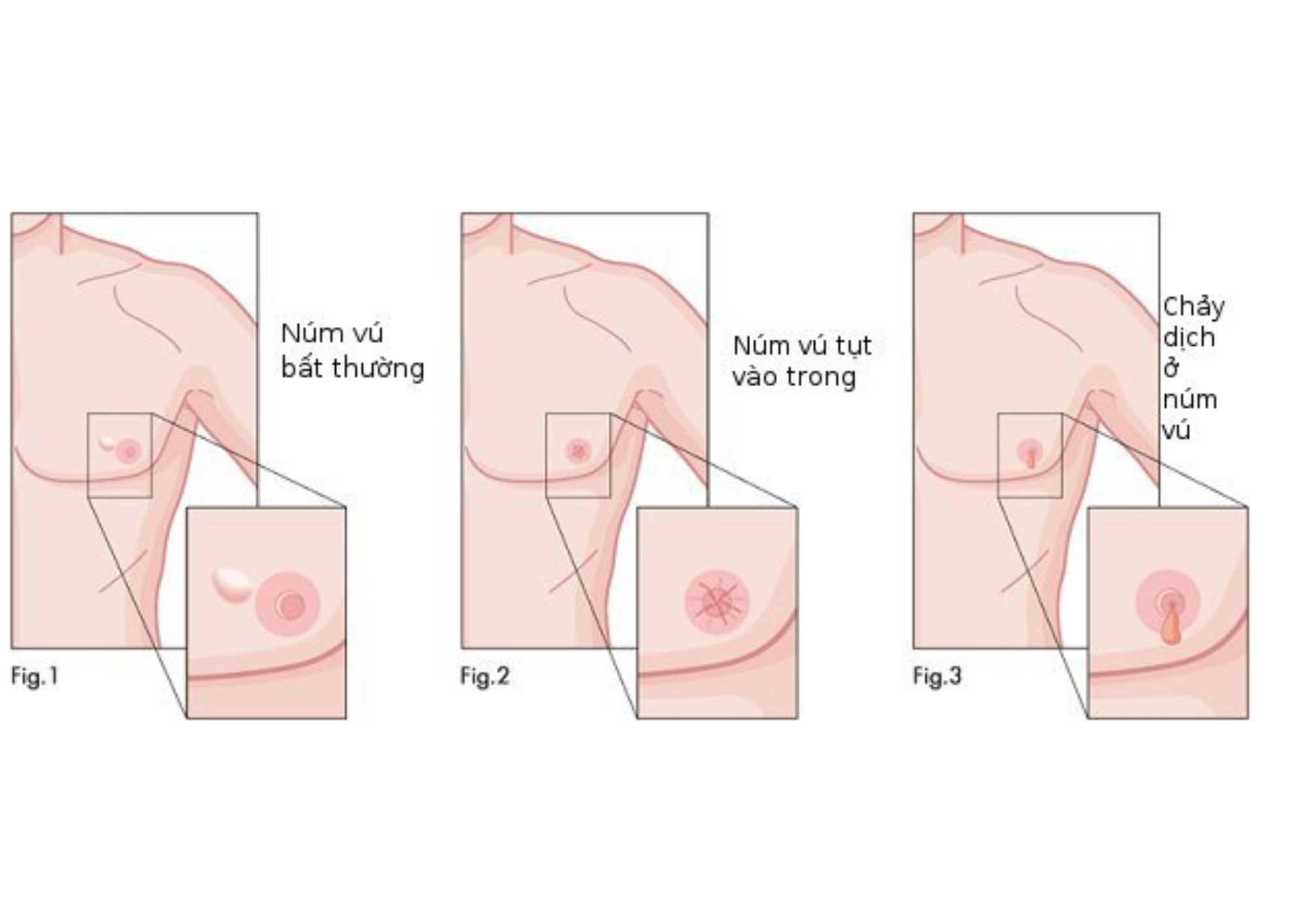 Ung thư vú ở nam là gì? Những điều cần biết về ung thư vú ở nam