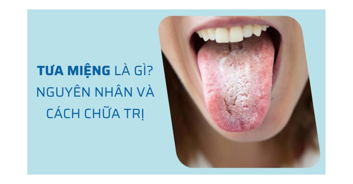Tưa miệng là gì? Những điều cần biết về tưa miệng