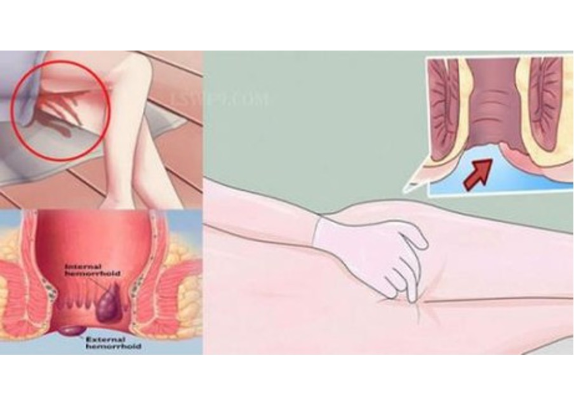 Ung Thư Ống Hậu Môn: Dấu hiệu, nguyên nhân và điều trị về bệnh này