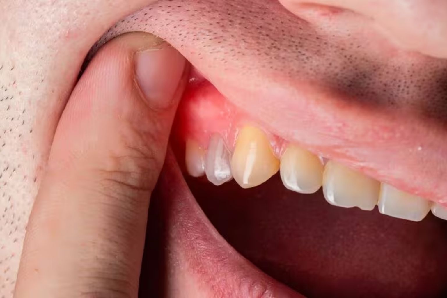 Sưng nướu là gì? Nguyên nhân, triệu chứng và cách điều trị