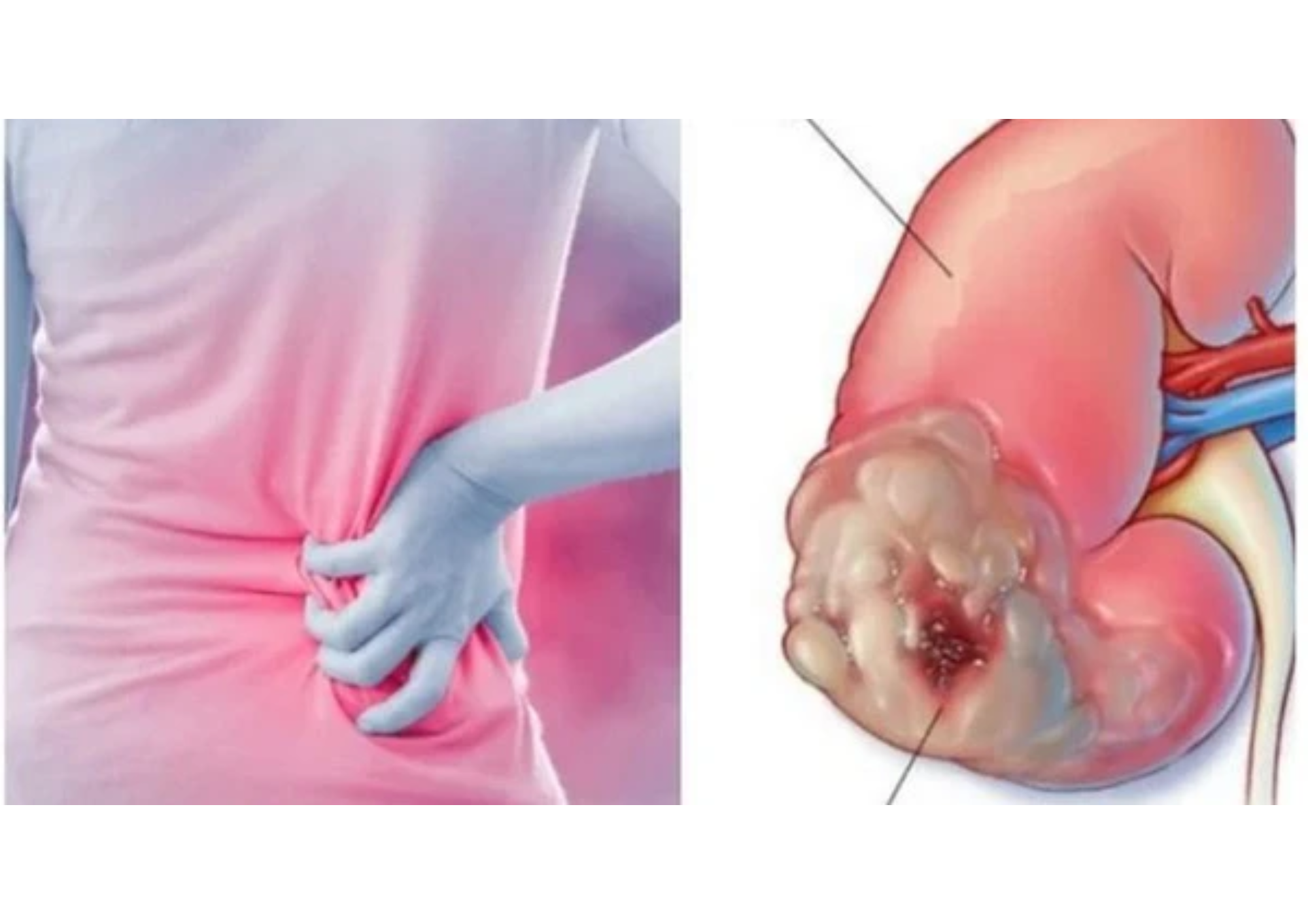 Ung Thư Thận: Dấu hiệu cảnh báo, Nguyên nhân và Phương pháp điều trị toàn diện
