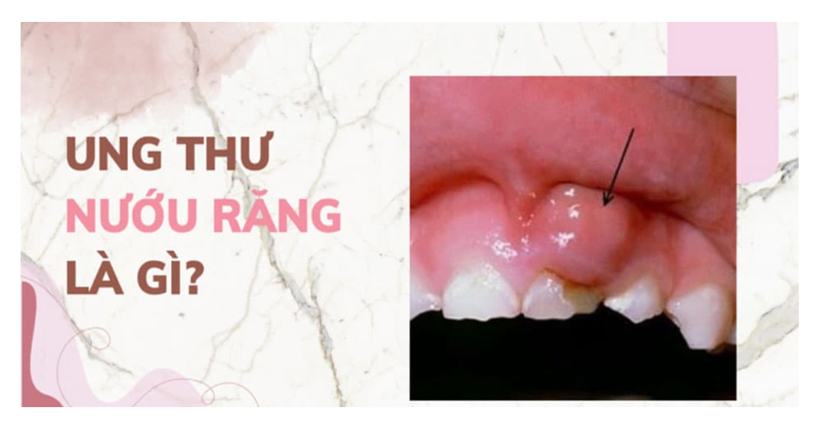 Ung thư nướu răng là gì? Những điều cần biết về ung thư nướu răng