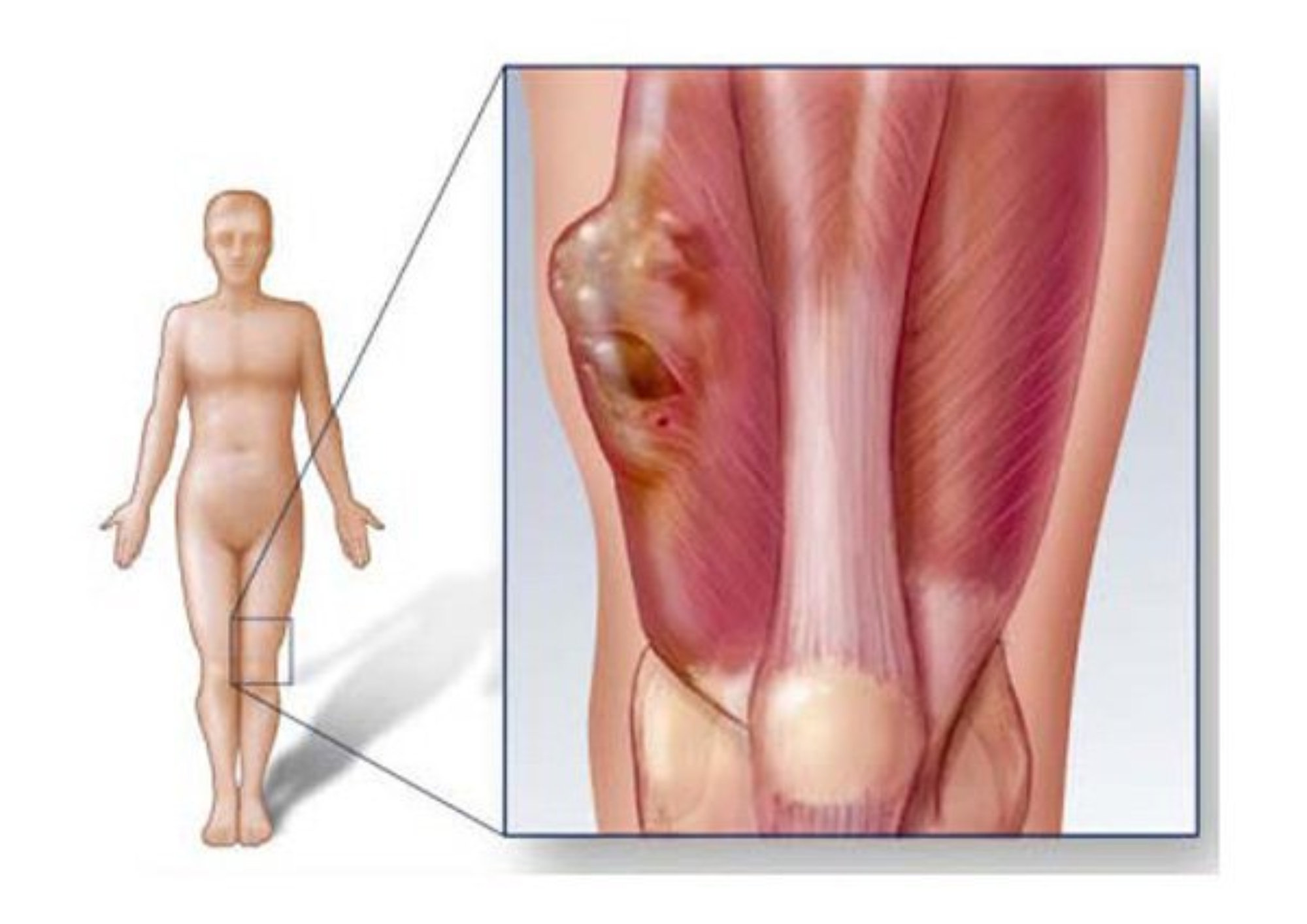 Bệnh Sarcoma Cơ Vân (Rhabdomyosarcoma): Những điều bạn cần biết về loại bệnh này