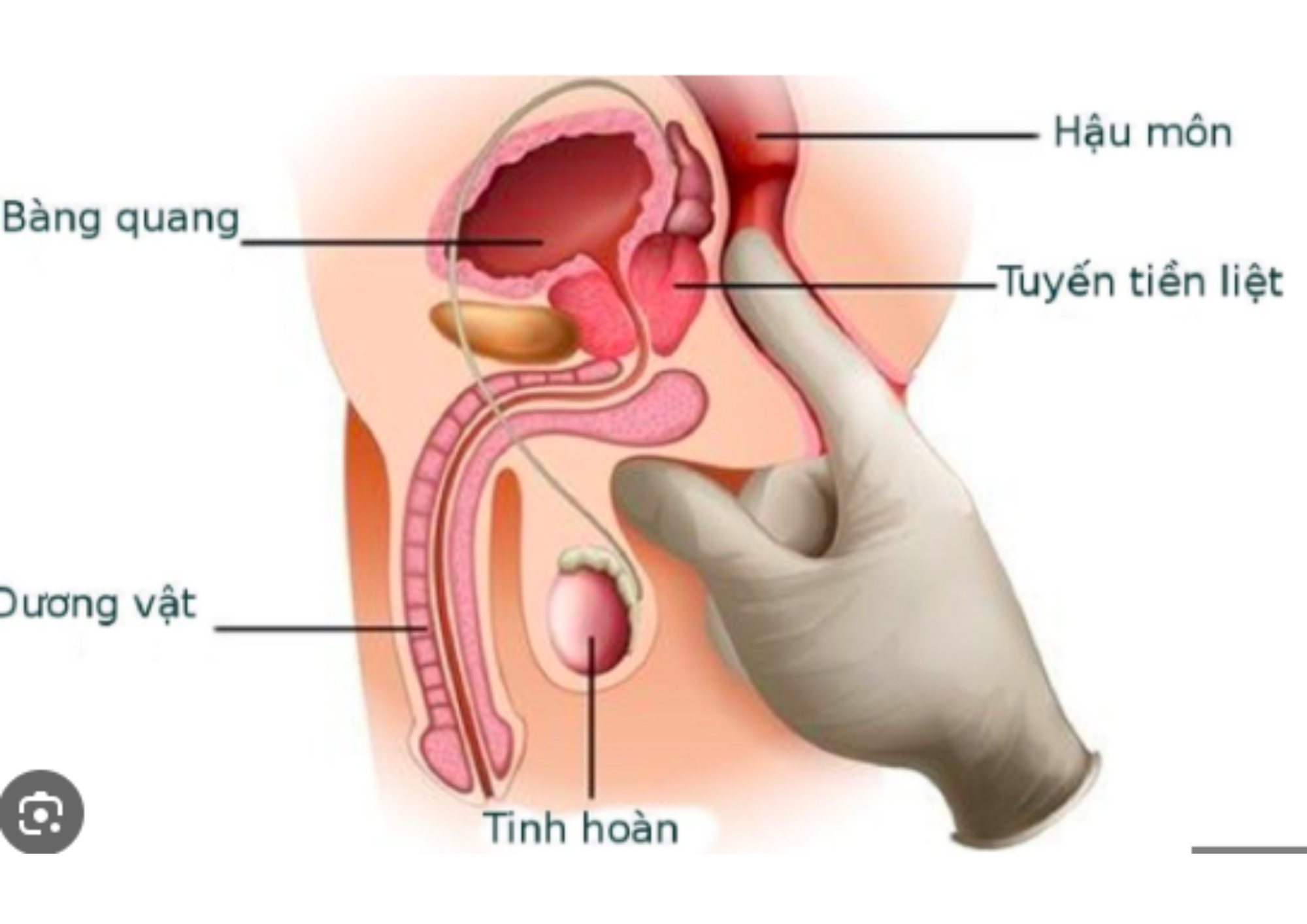 Ung Thư Dương Vật: Dấu hiệu, Nguyên nhân và Các biện pháp Điều trị