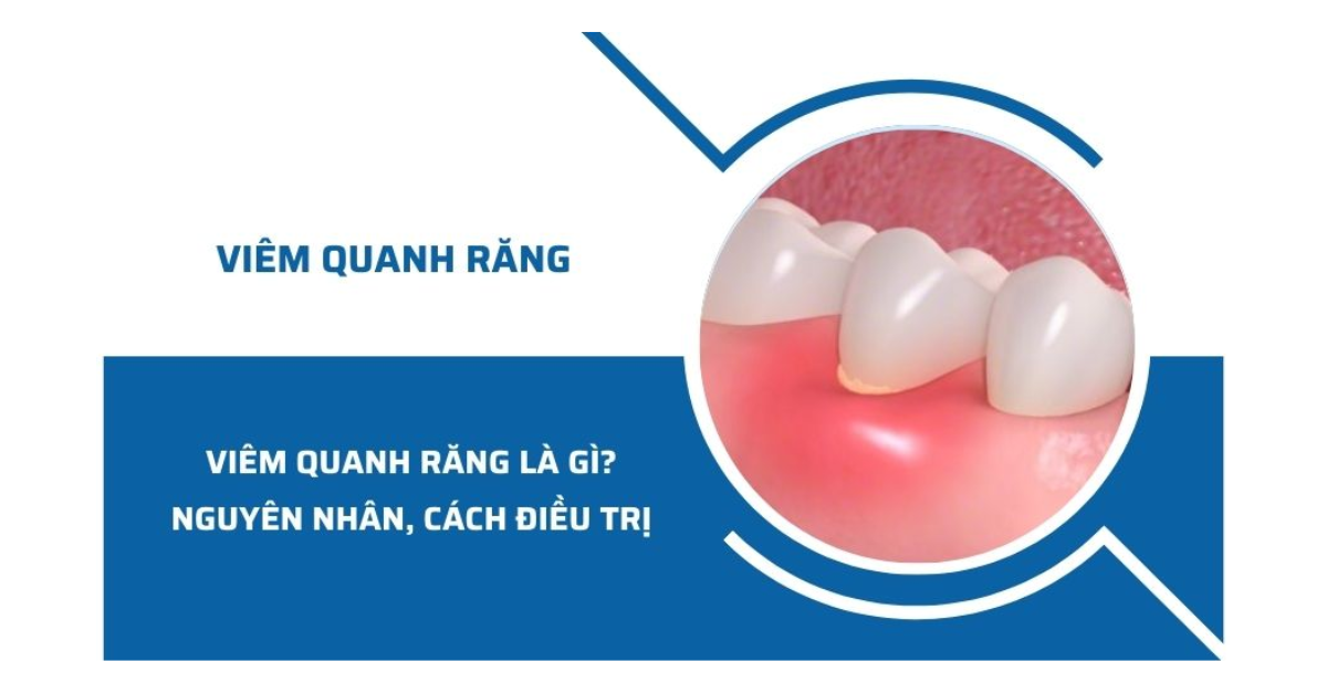 Viêm quanh răng là gì? Những điều cần biết về viêm quanh răng