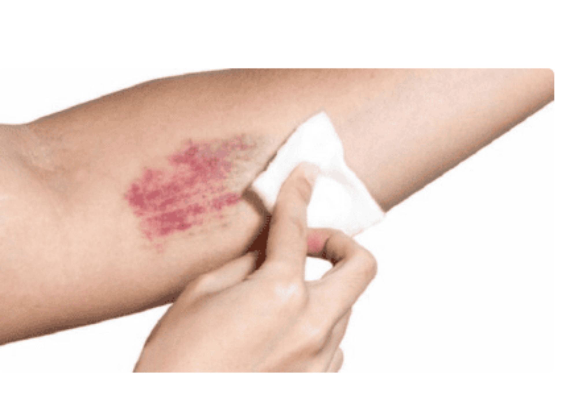 Giảm tiểu cầu miễn dịch có điều trị khỏi được không?