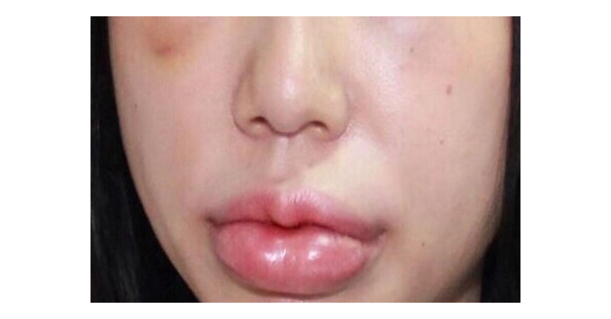 Sưng môi là gì? Dấu hiệu, nguyên nhân, chẩn đoán và điều trị