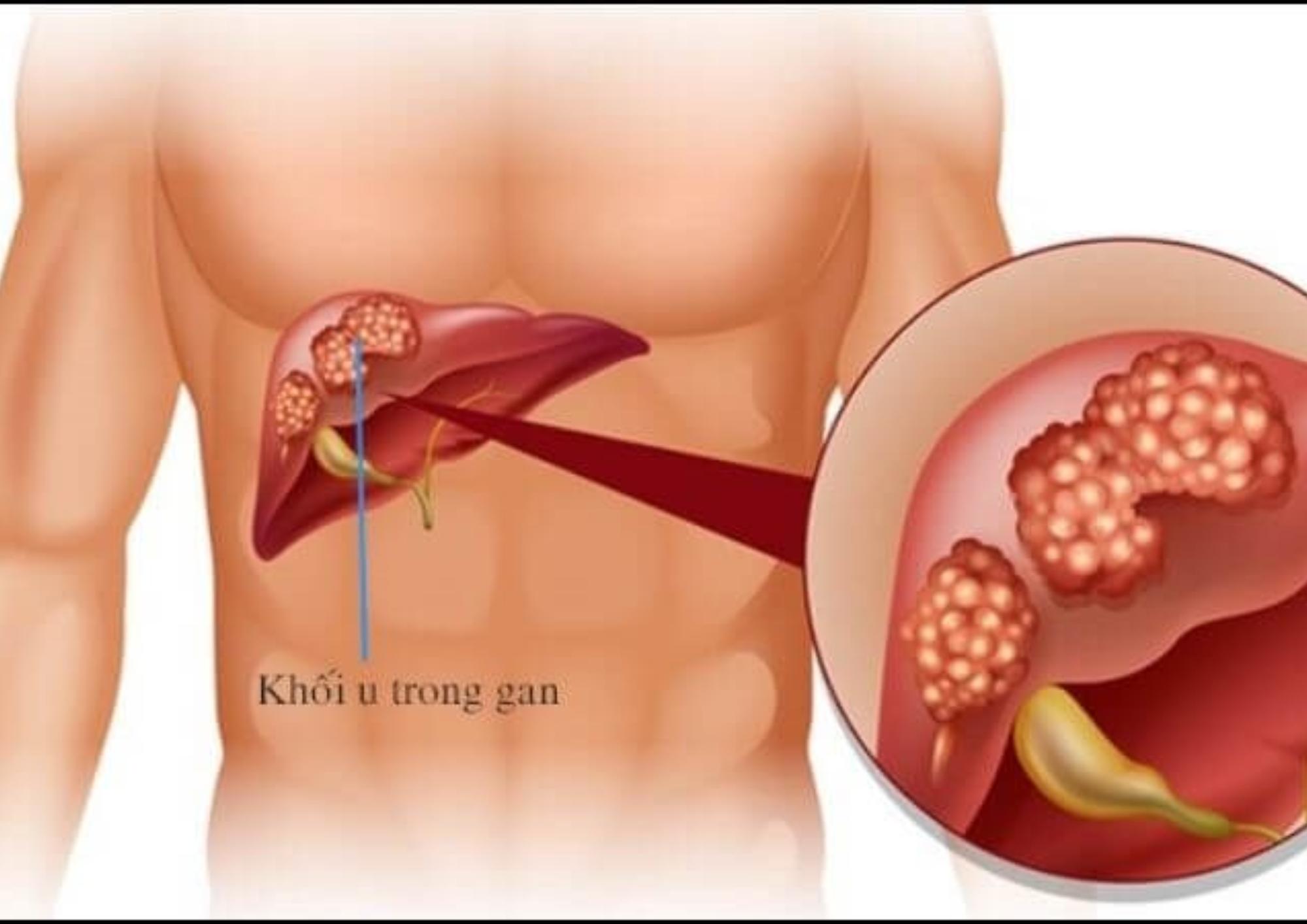 Ung Thư Biểu Mô Tế Bào Gan: Nguyên Nhân, Triệu Chứng và Cách Điều Trị