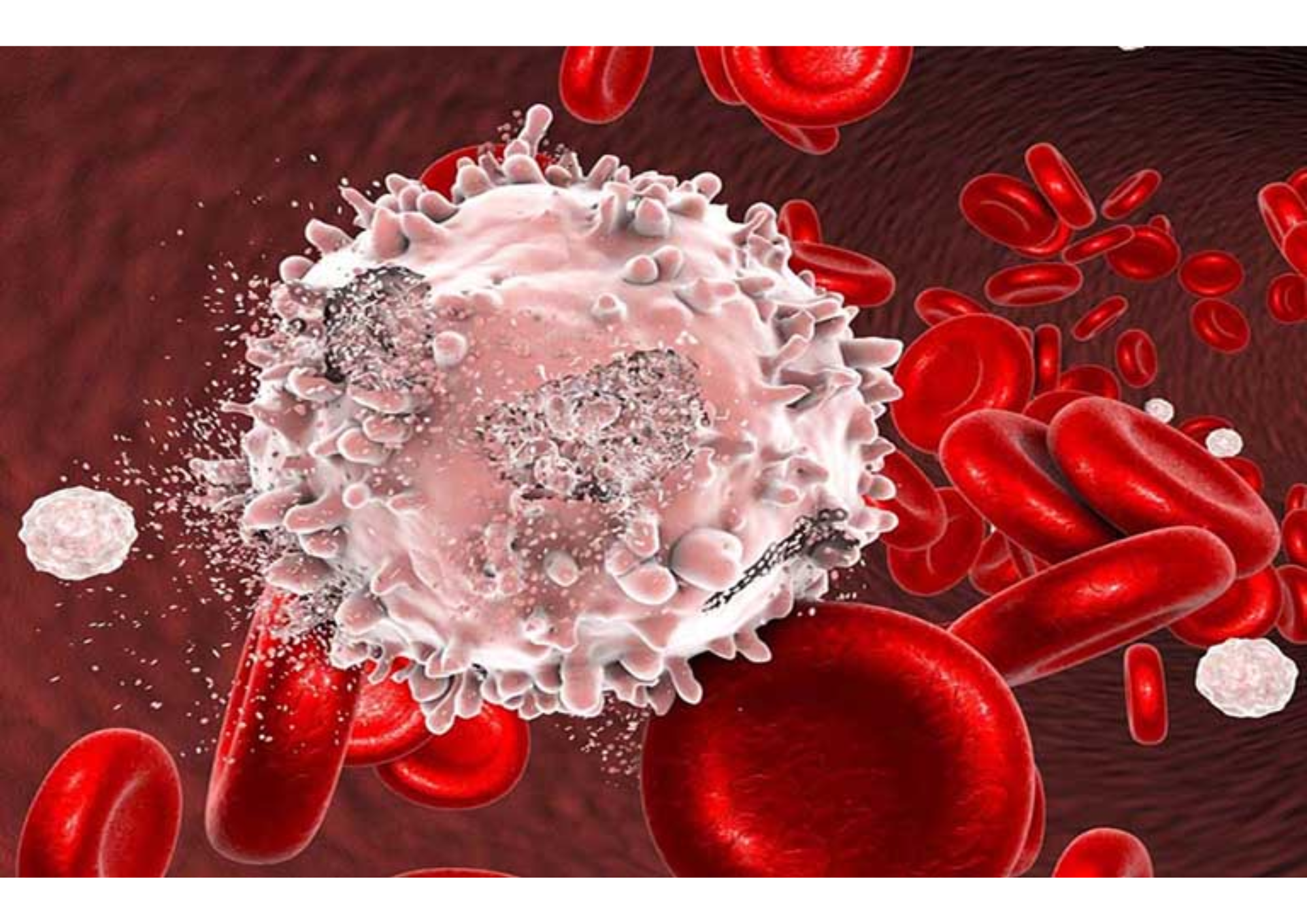Ung Thư Máu Cấp Tính (Leukemia): Nỗi Ám Ảnh và Giải Pháp Bảo vệ Sức Khỏe